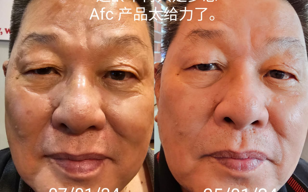 After taking AFC, wrinkles fade, and skin becomes smooth.