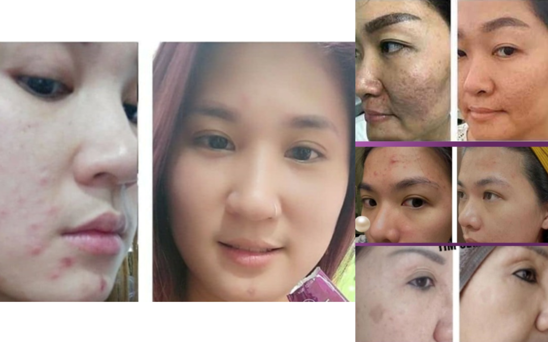 After taking 5 packs of Utsukushhii, the skin became noticeably smoother.