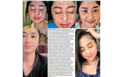 Simptom LONG COVID sembuh