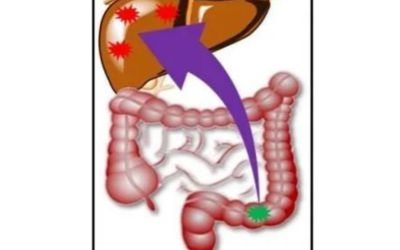 Karsinoma Kolon Tahap 4 Pulih Setelah Mengambil Makanan Super AFC