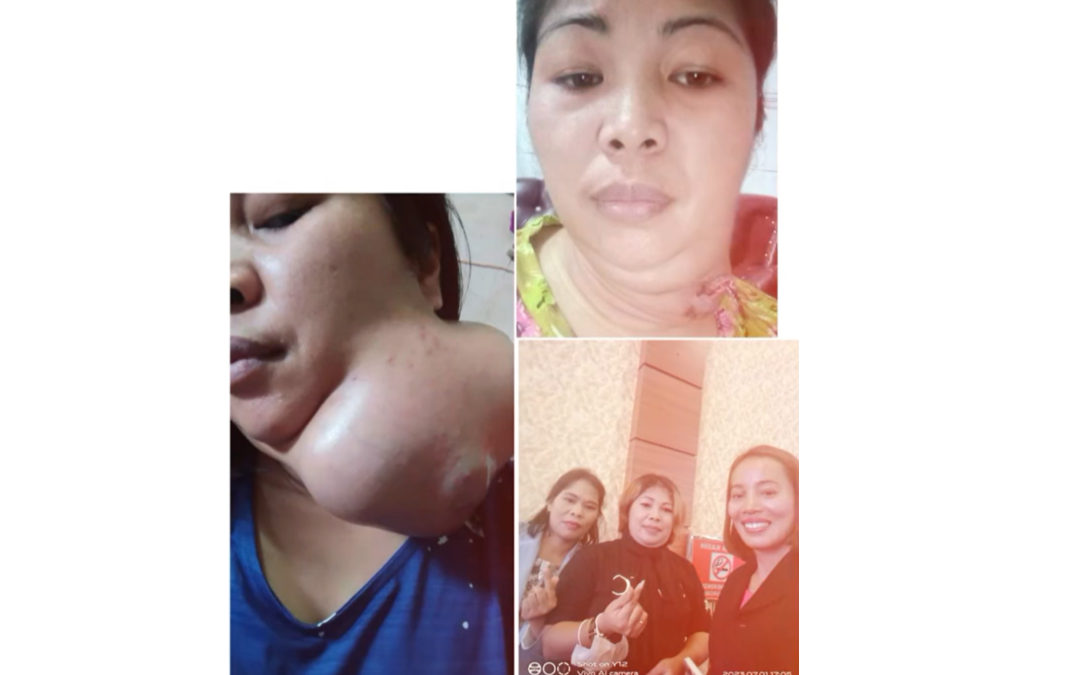 Tiada lagi tanda-tanda tumor kanser, dan ia mula mengecil selepas mengambil selama 14 hari.