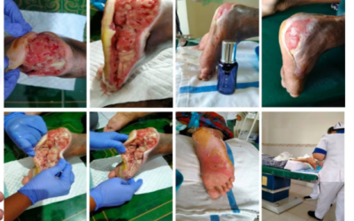 Gangren kaki akibat kencing manis mukjizat dipulihkan tanpa perlu potong kaki